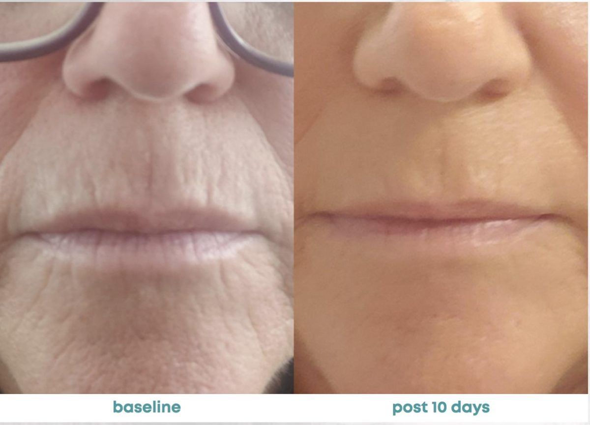 Accent Prime Skin Rejuvenation Renuvia Med Spa New Port Richey