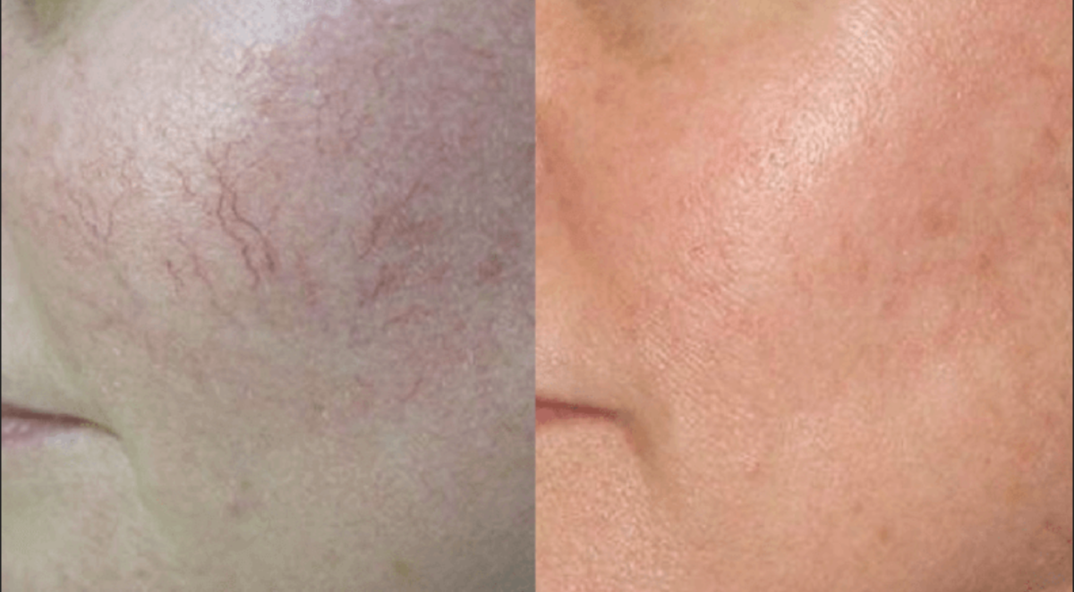 DYE VL Skin Rejuvenation Renuvia Med Spa New Port Richey