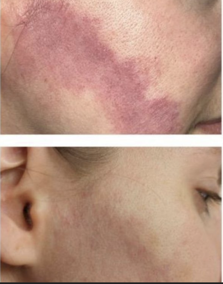 DYE VL Skin Rejuvenation Renuvia Med Spa New Port Richey