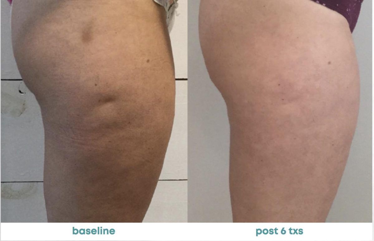 Accent Prime Skin Rejuvenation Renuvia Med Spa New Port Richey