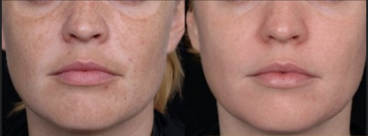 DYE VL Skin Rejuvenation Renuvia Med Spa New Port Richey