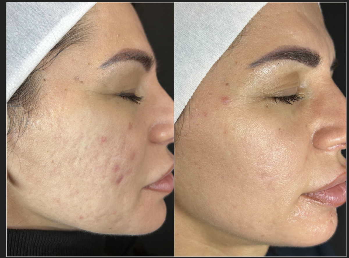 CO2 Laser Skin Rejuvenation Renuvia Med Spa New Port Richey