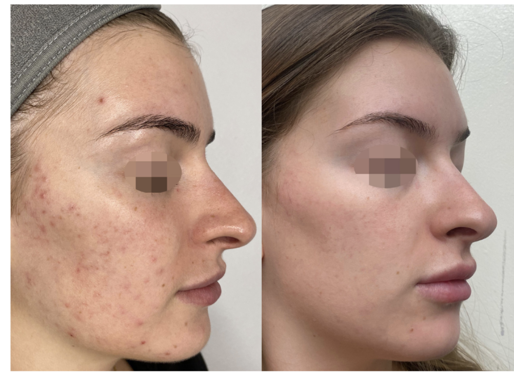 CO2 Laser Skin Rejuvenation Renuvia Med Spa New Port Richey