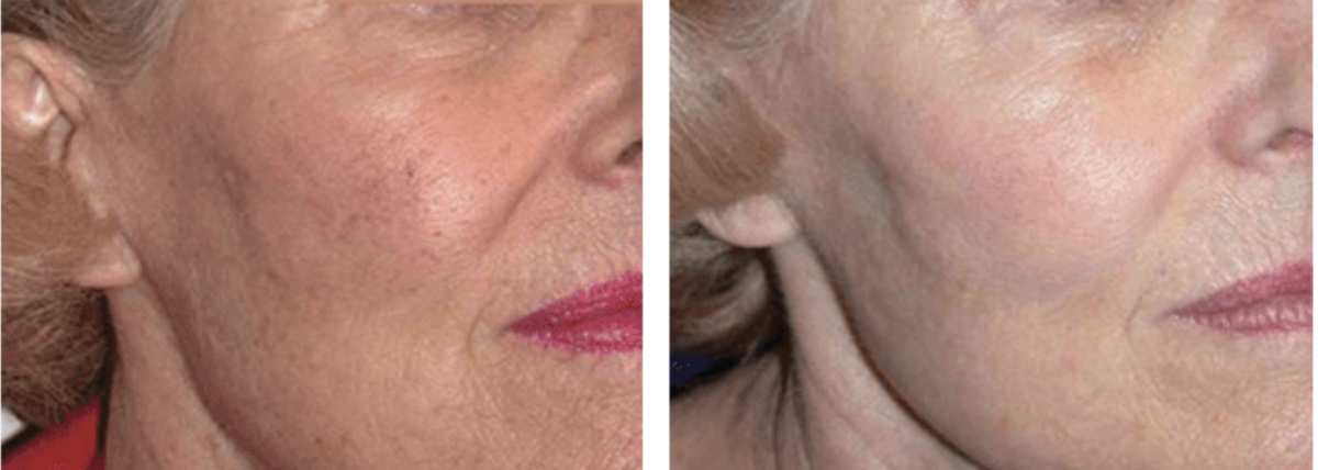 DYE VL Skin Rejuvenation Renuvia Med Spa New Port Richey