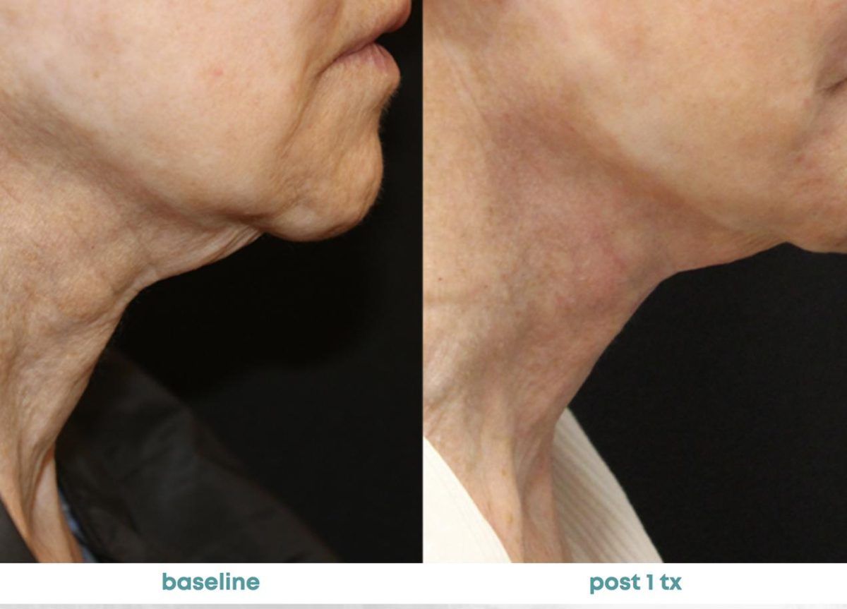 Accent Prime Skin Rejuvenation Renuvia Med Spa New Port Richey