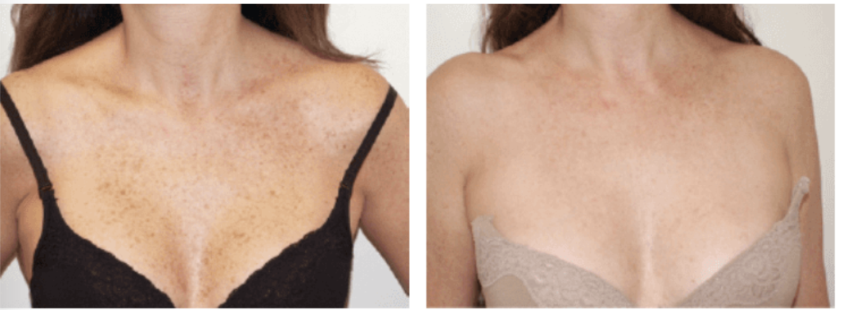 DYE VL Skin Rejuvenation Renuvia Med Spa New Port Richey