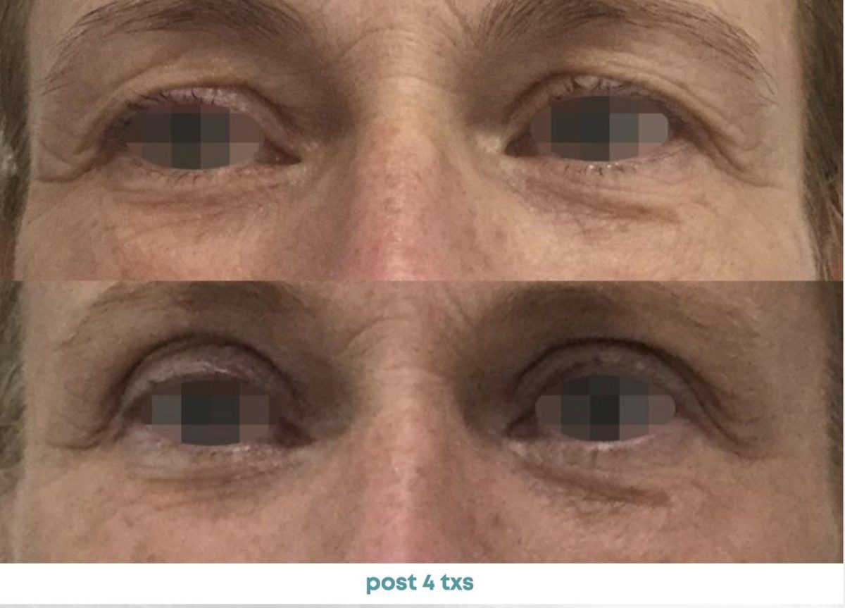 Accent Prime Skin Rejuvenation Renuvia Med Spa New Port Richey