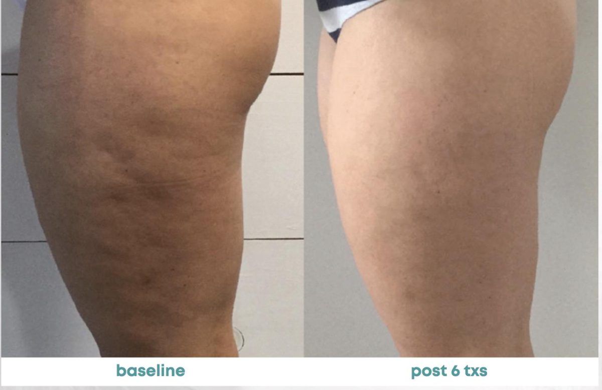 Accent Prime Skin Rejuvenation Renuvia Med Spa New Port Richey