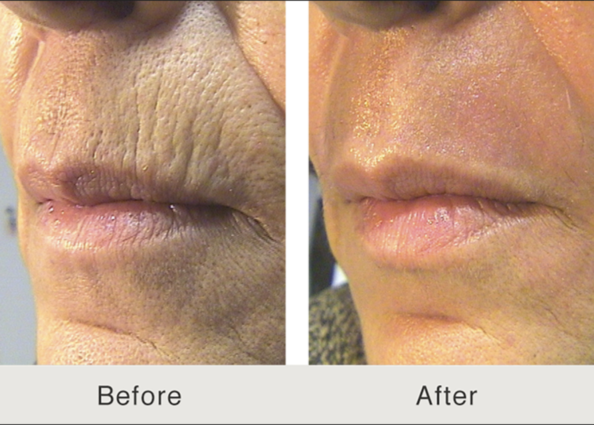 CO2 Laser Skin Rejuvenation Renuvia Med Spa New Port Richey