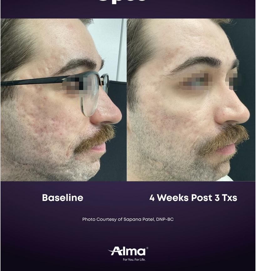 Accent Prime Skin Rejuvenation Renuvia Med Spa New Port Richey