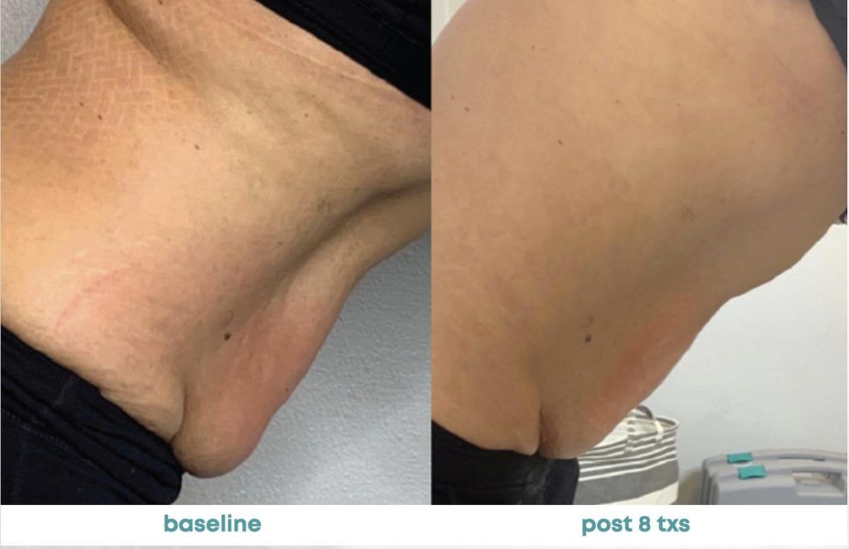 Accent Prime Skin Rejuvenation Renuvia Med Spa New Port Richey