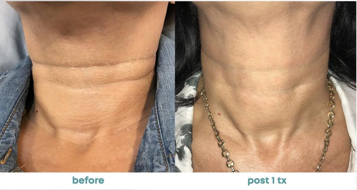 Accent Prime Skin Rejuvenation Renuvia Med Spa New Port Richey