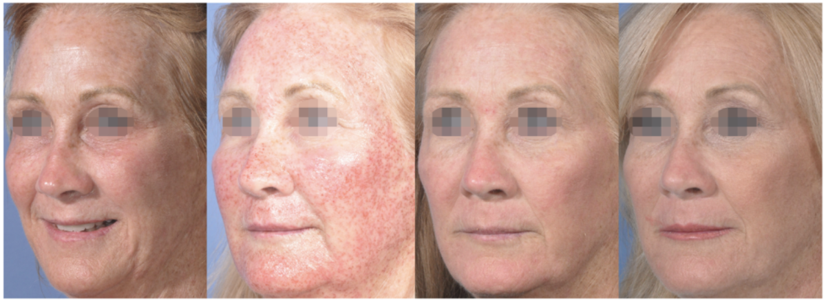 CO2 Laser Skin Rejuvenation Renuvia Med Spa New Port Richey