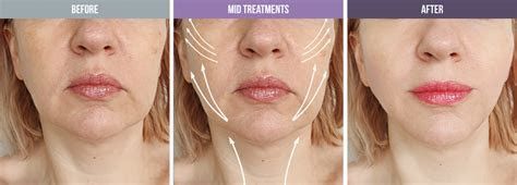 Accent Prime Skin Rejuvenation Renuvia Med Spa New Port Richey