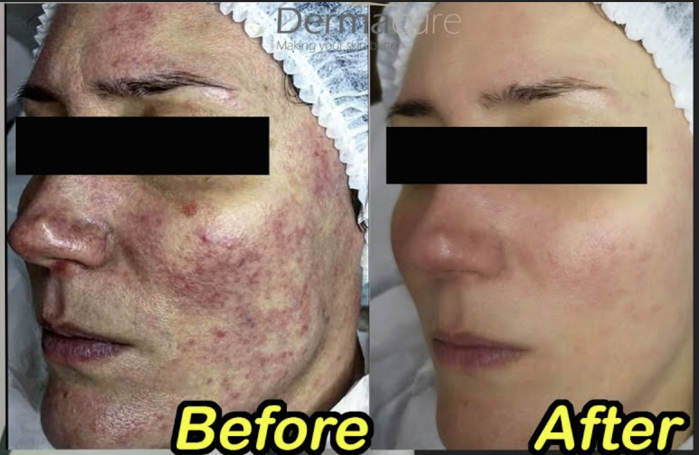 DYE VL Skin Rejuvenation Renuvia Med Spa New Port Richey