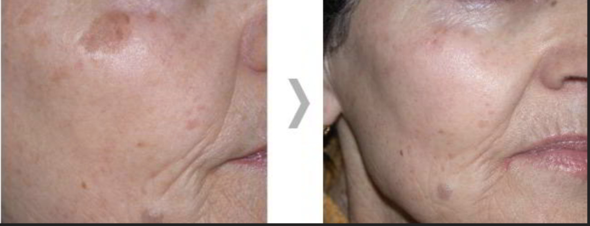 DYE VL Skin Rejuvenation Renuvia Med Spa New Port Richey