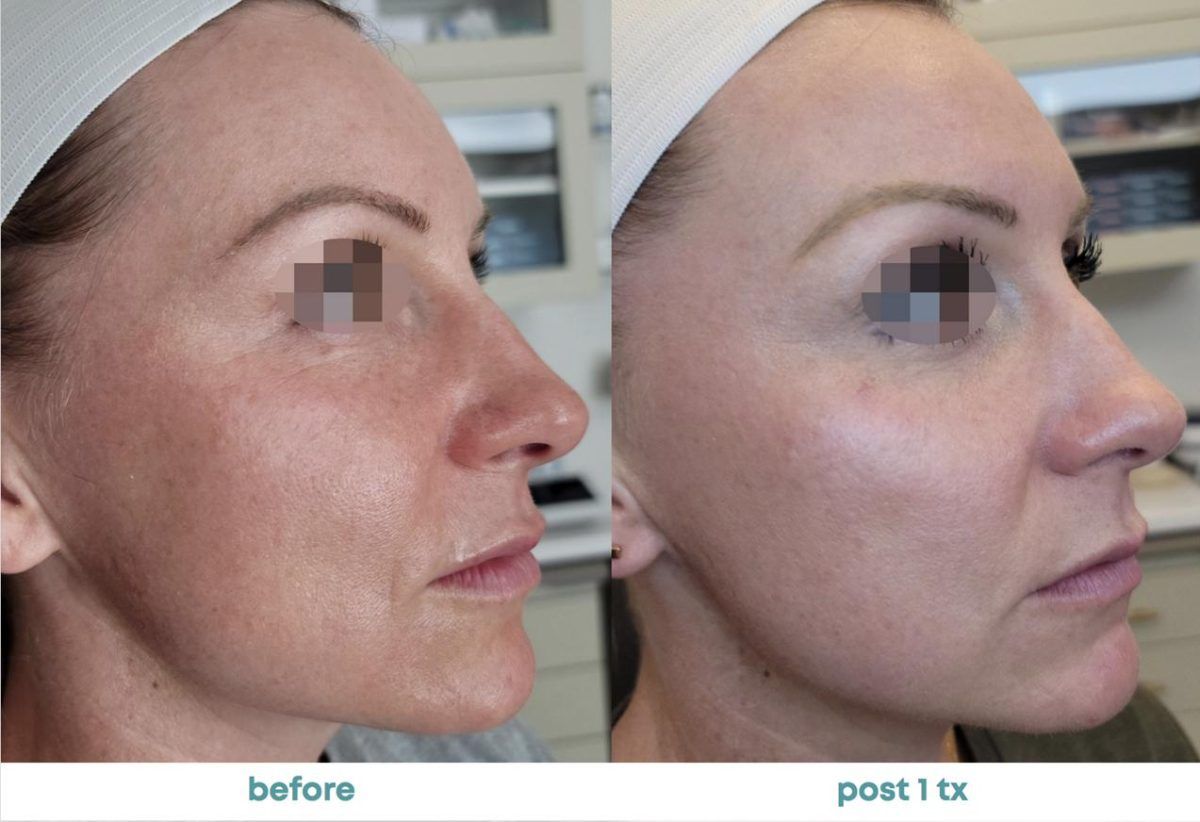 Accent Prime Skin Rejuvenation Renuvia Med Spa New Port Richey