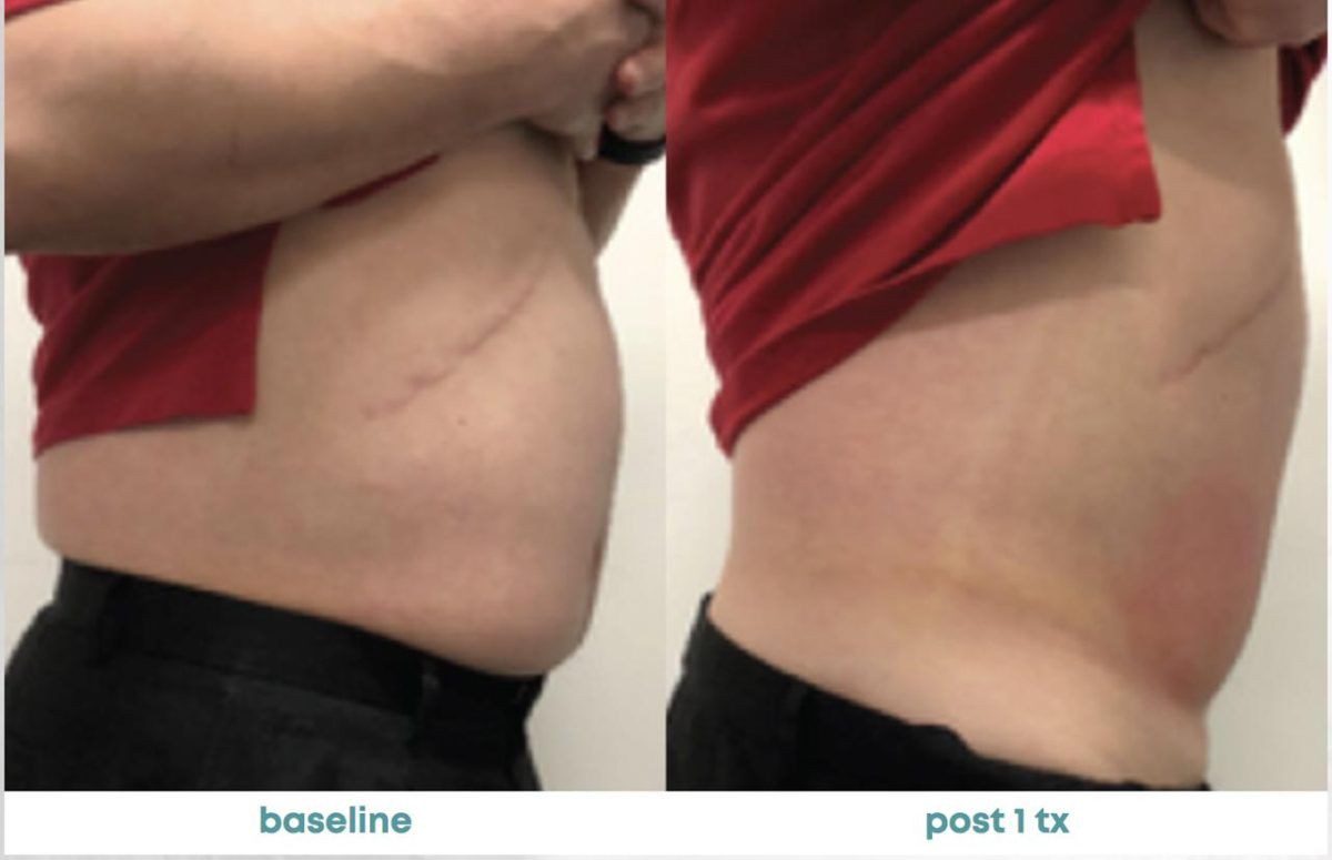 Accent Prime Skin Rejuvenation Renuvia Med Spa New Port Richey