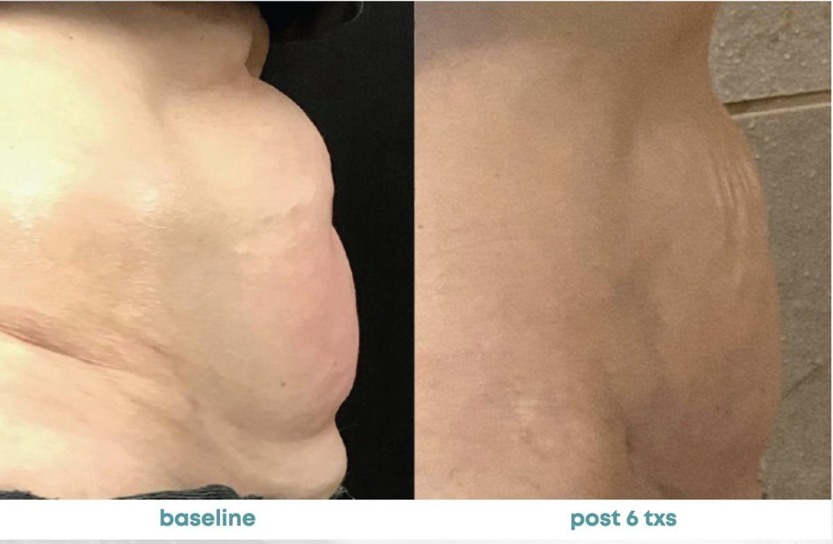 Accent Prime Skin Rejuvenation Renuvia Med Spa New Port Richey