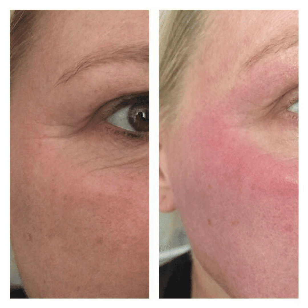 Accent Prime Skin Rejuvenation Renuvia Med Spa New Port Richey