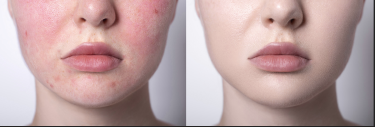 DYE VL Skin Rejuvenation Renuvia Med Spa New Port Richey